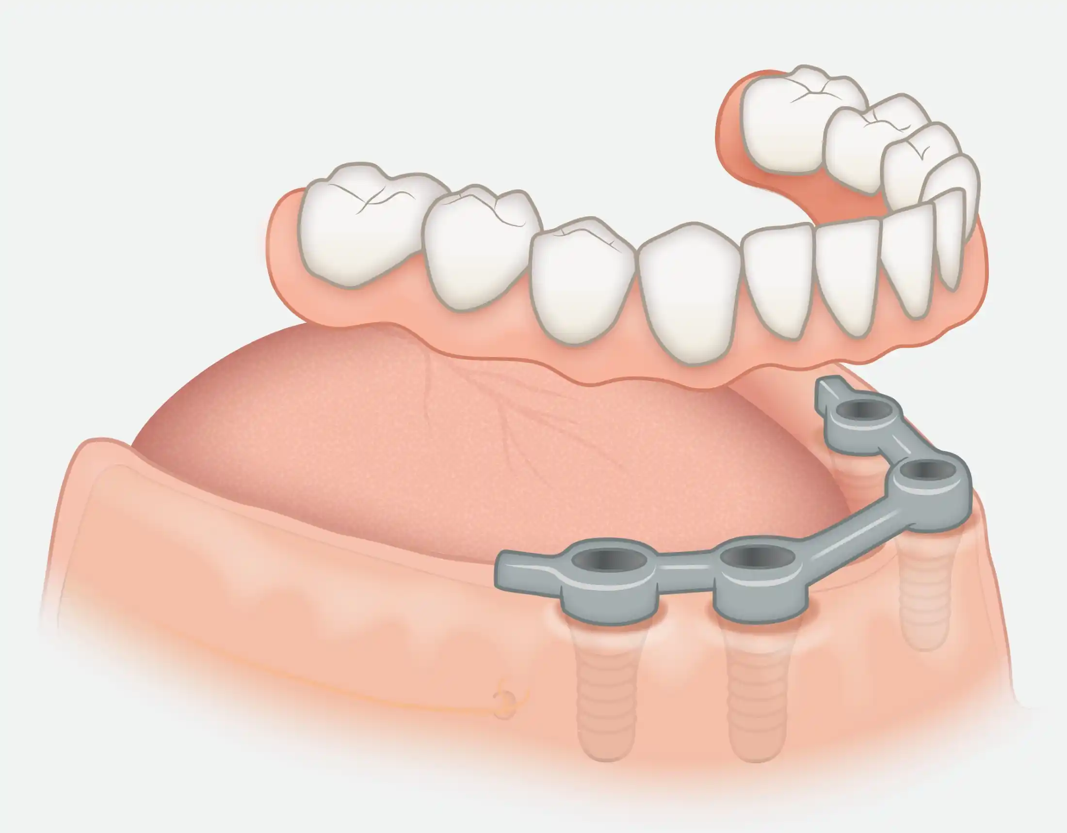 Removable dentures