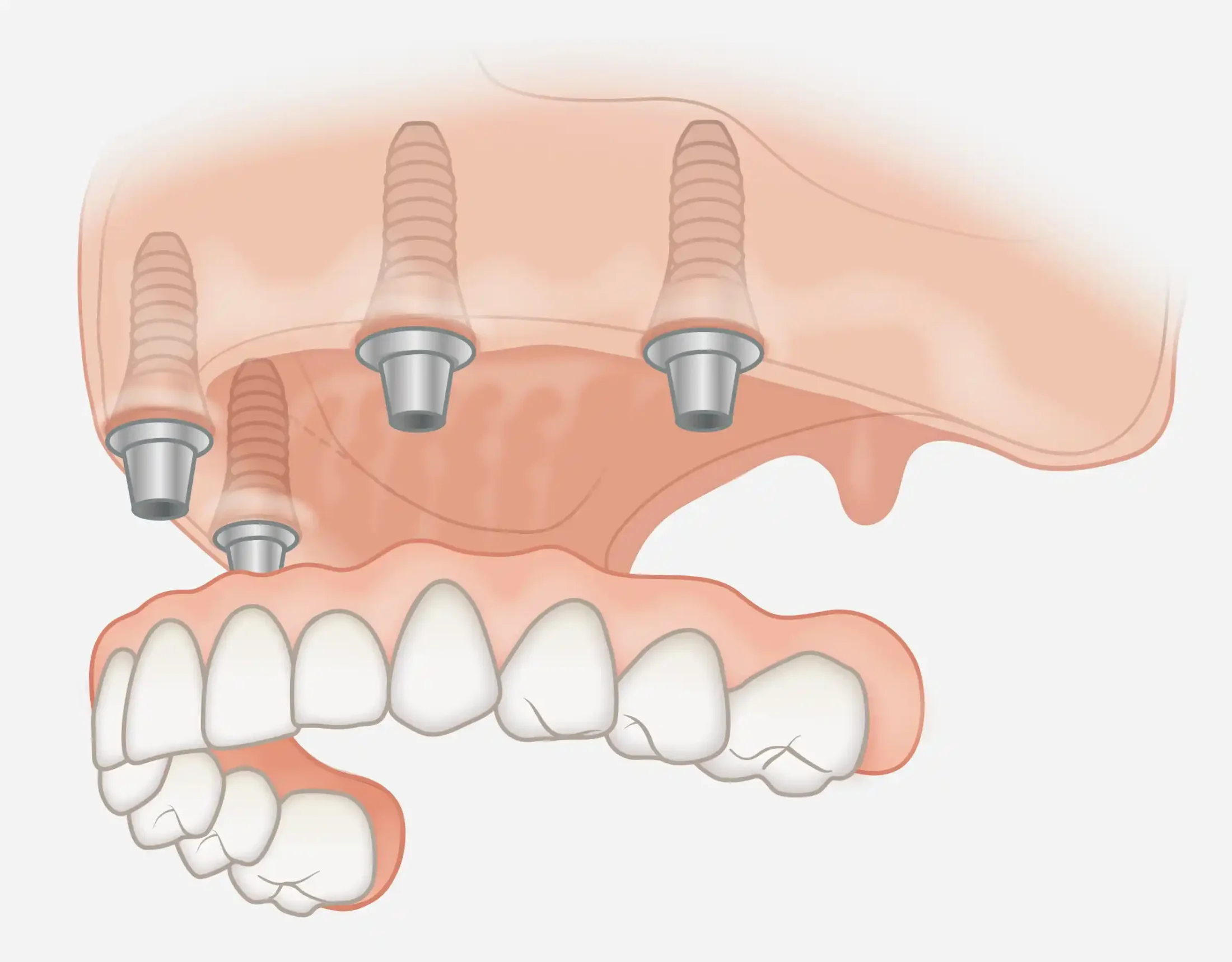 Implant-supported removable dentures
