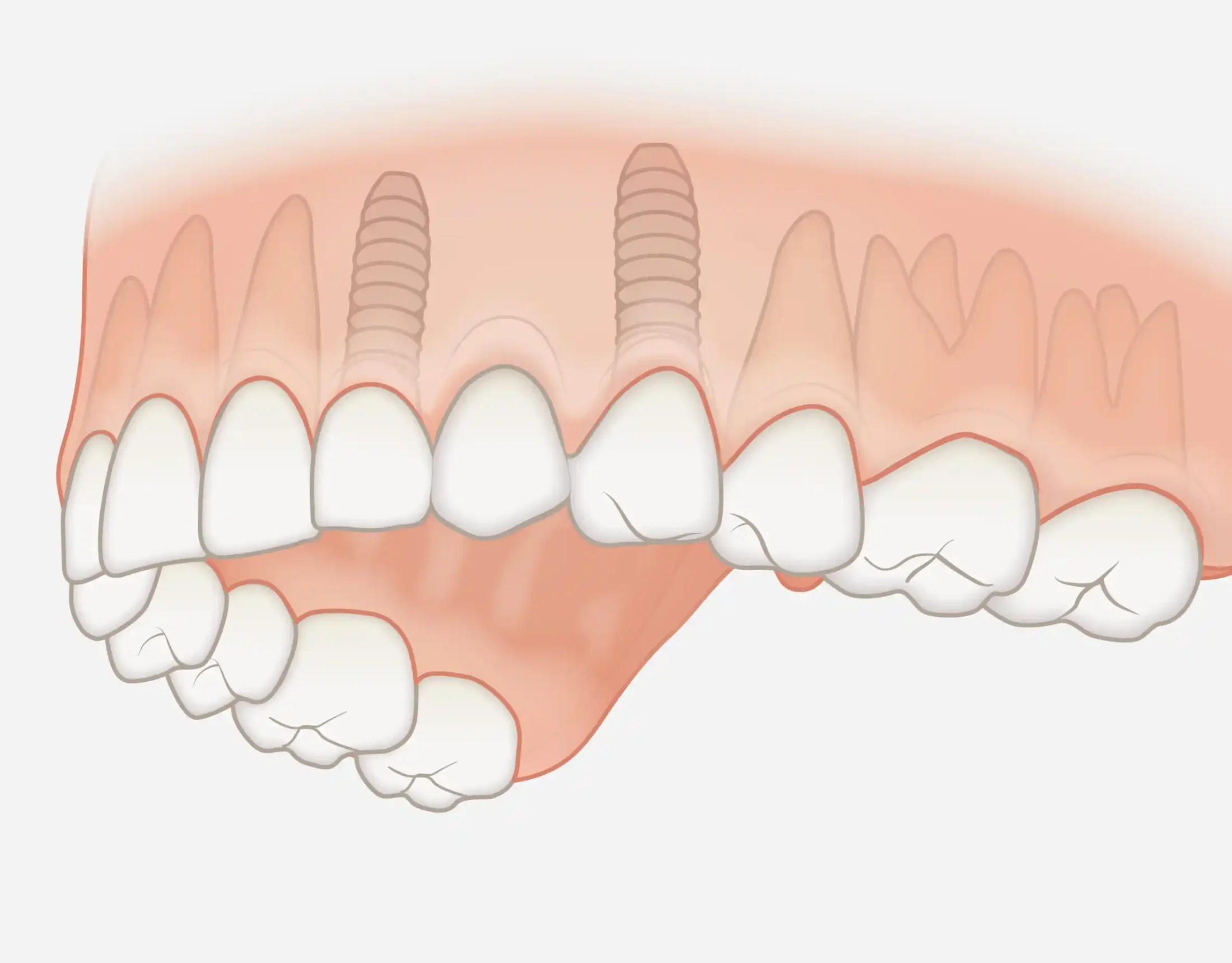 Group-tooth implant restoration