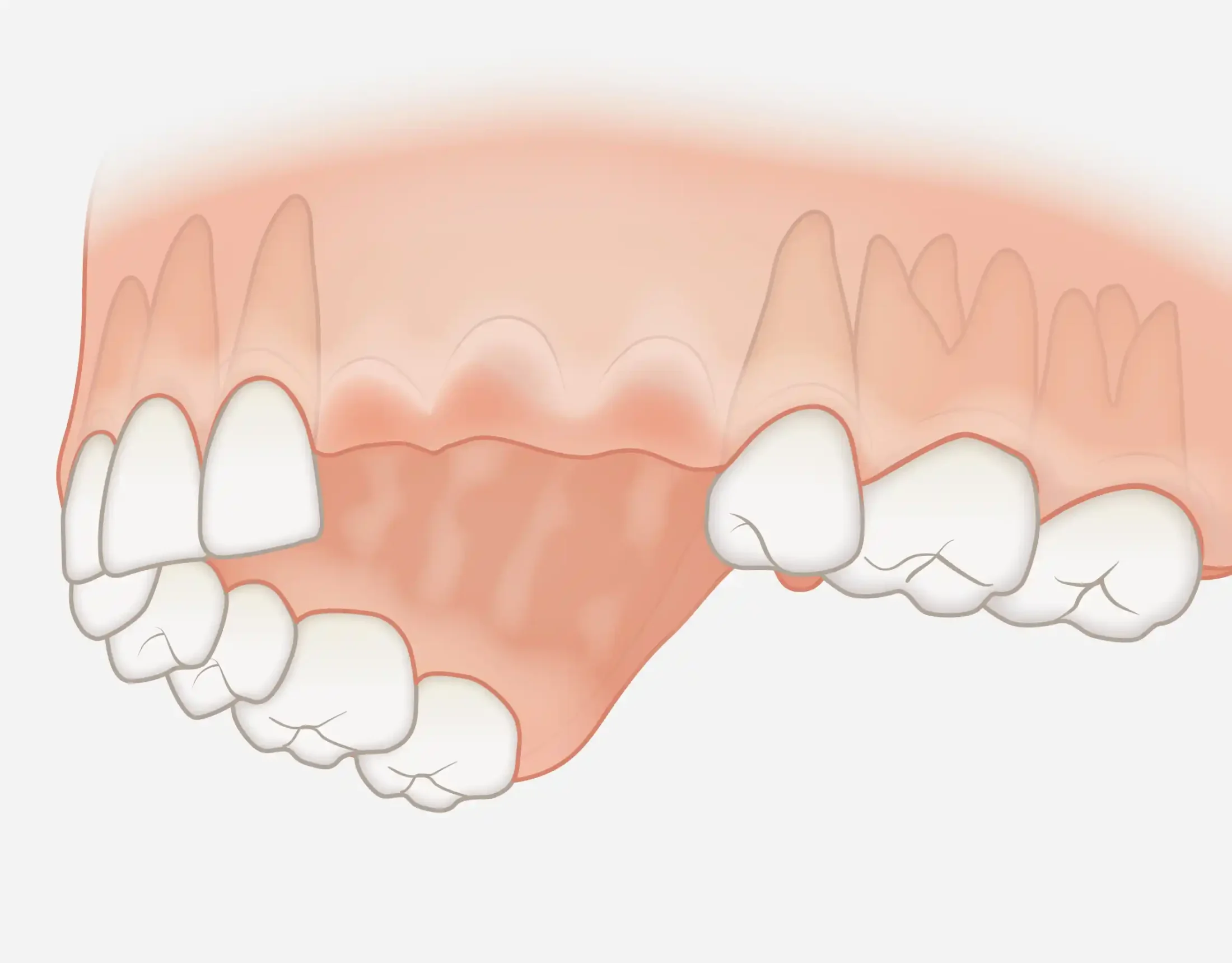 Replacement of a group of teeth
