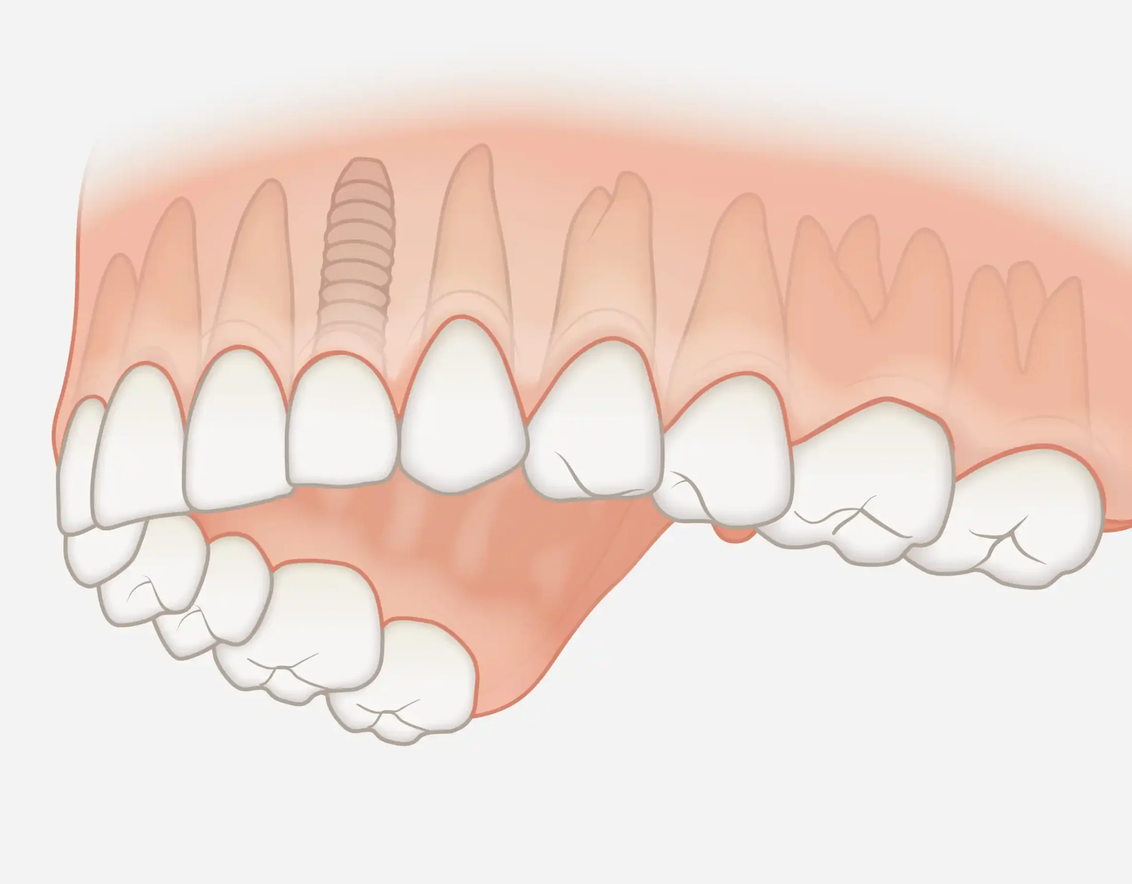 Single-tooth implant restoration