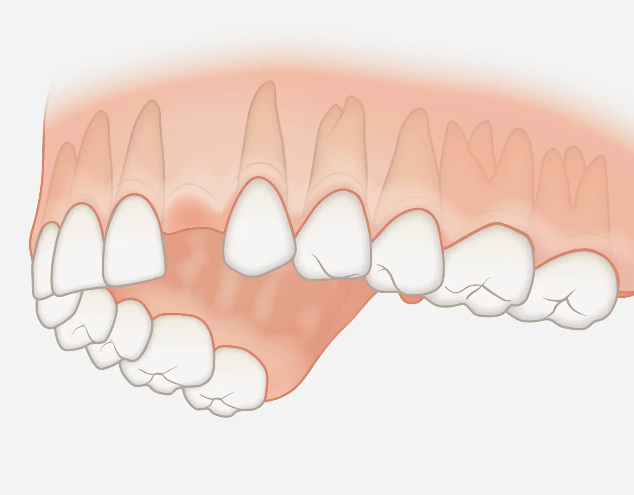 Single-tooth replacement